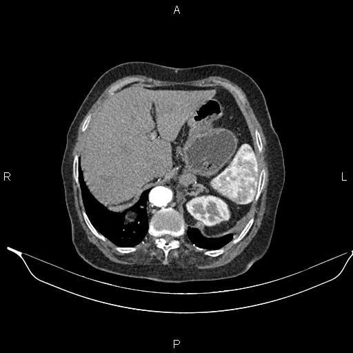 File:Abdominal aortic aneurysm (Radiopaedia 85063-100606 Axial C+ arterial phase 30).jpg