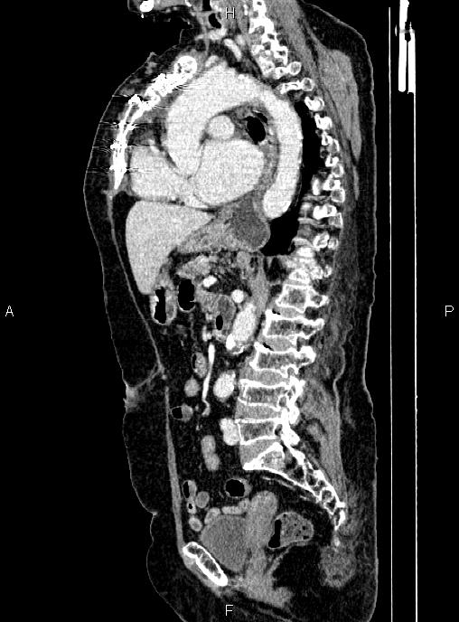 Abdominal aortic aneurysm (Radiopaedia 85063-100606 Sagittal C+ arterial phase 45).jpg