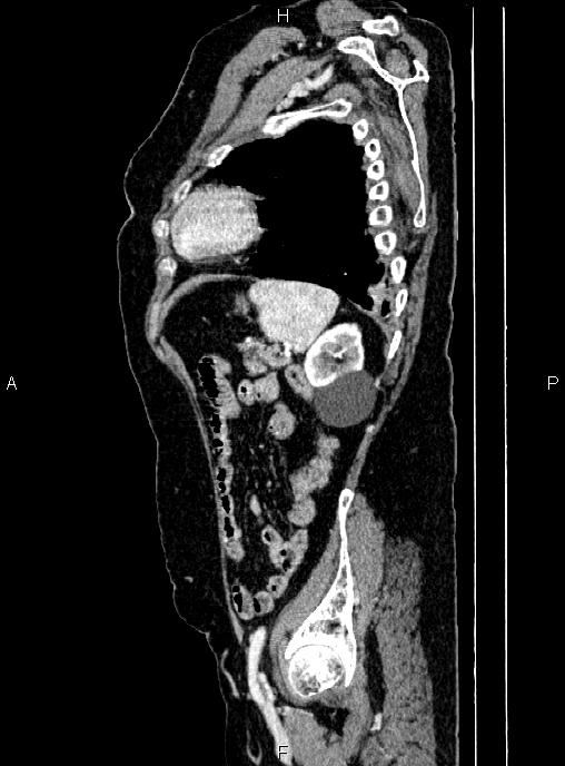 Abdominal aortic aneurysm (Radiopaedia 85063-100606 Sagittal C+ arterial phase 66).jpg