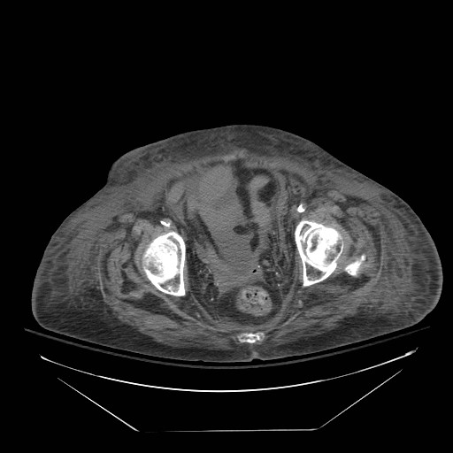 Abdominal aortic aneurysm - impending rupture (Radiopaedia 19233-19247 Axial non-contrast 150).jpg
