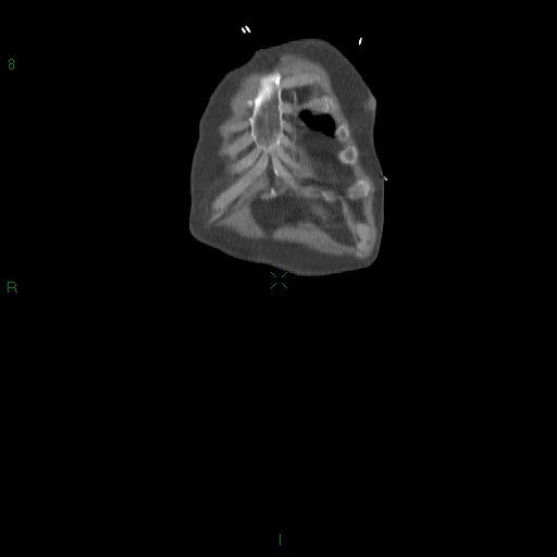 File:Abdominal aortic aneurysm rupture with aortocaval fistula (Radiopaedia 14897-14841 Coronal C+ arterial phase 11).jpg