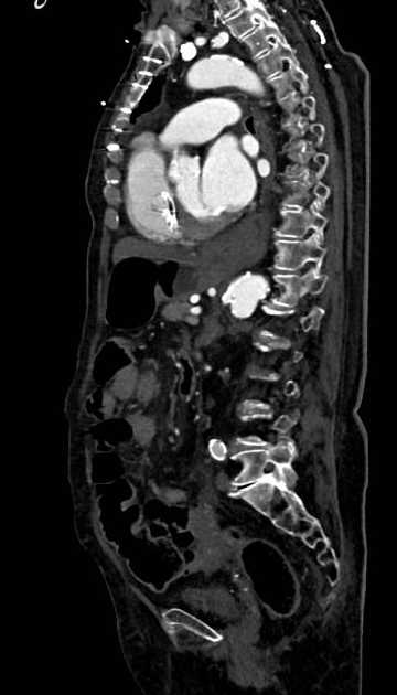 Abdominal aortic aneurysm with thrombus fissuration (Radiopaedia 73192-83919 Sagittal C+ arterial phase 58).jpg