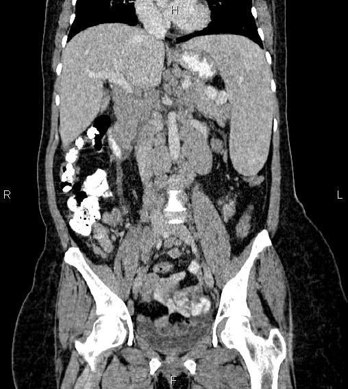 File:Abdominal lymphoma with sandwich sign (Radiopaedia 84378-99704 Coronal C+ portal venous phase 32).jpg