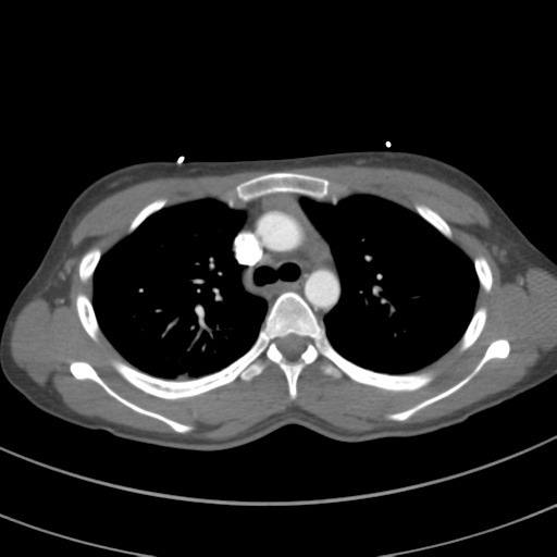 File:Abdominal multi-trauma - devascularised kidney and liver, spleen and pancreatic lacerations (Radiopaedia 34984-36486 Axial C+ arterial phase 29).png