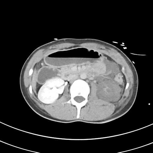 File:Abdominal multi-trauma - devascularised kidney and liver, spleen and pancreatic lacerations (Radiopaedia 34984-36486 Axial C+ delayed 33).png