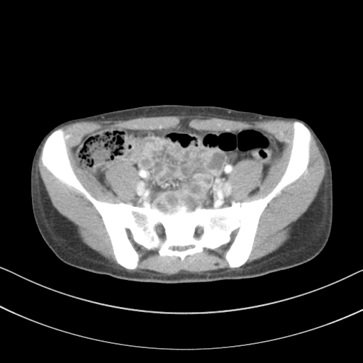 Abdominal multi-trauma - devascularised kidney and liver, spleen and pancreatic lacerations (Radiopaedia 34984-36486 Axial C+ portal venous phase 62).png