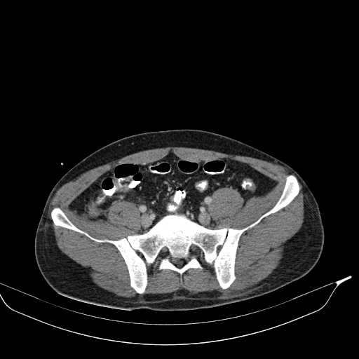 File:Abdominal multiorgan trauma (Radiopaedia 21792-21754 Axial C+ portal venous phase 40).jpg