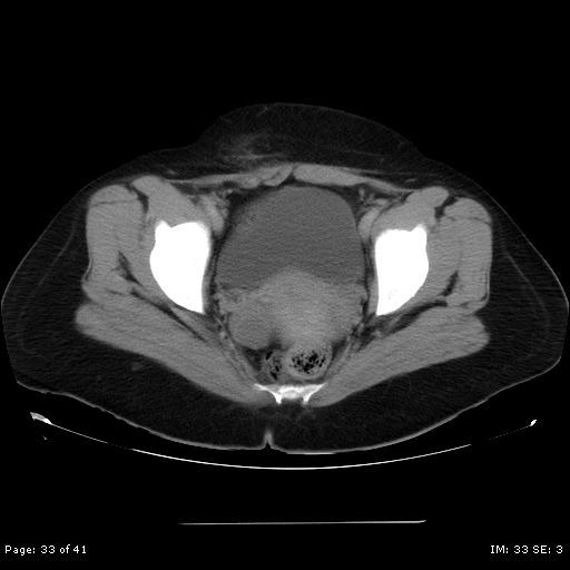 File:Abdominal wall endometriosis (Radiopaedia 25723-25885 Axial C+ portal venous phase 33).jpg