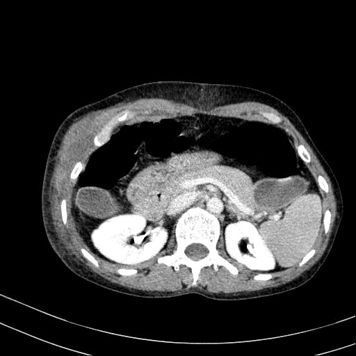 Abdominal wall hematoma with active bleeding (Radiopaedia 83915-99117 Axial C+ portal venous phase 12).jpg