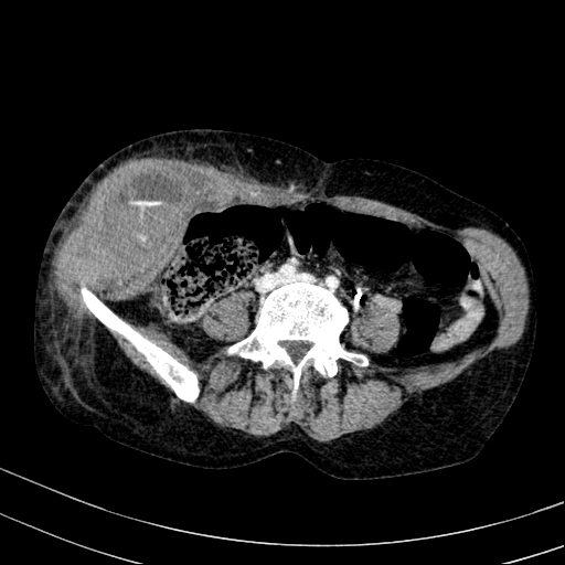 Abdominal wall hematoma with active bleeding (Radiopaedia 83915-99117 Axial C+ portal venous phase 73).jpg