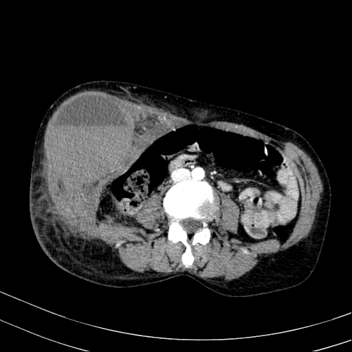 Abdominal wall hematoma with active bleeding (Radiopaedia 83915-99117 Axial renal cortical phase 53).jpg