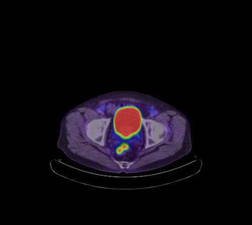 File:Abdominal wall metastasis from colorectal carcinoma (Radiopaedia 31016-31719 Axial 28).jpg