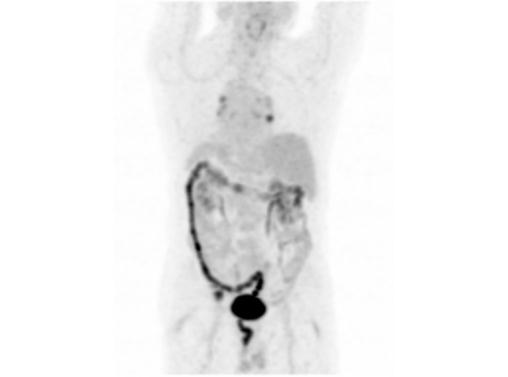 File:Abdominal wall metastasis from colorectal carcinoma (Radiopaedia 31016-31719 Rotational MIP 17).jpg