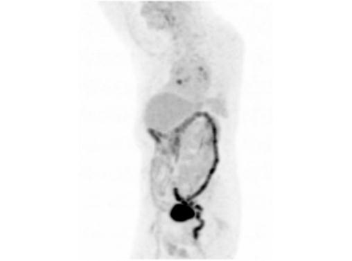 File:Abdominal wall metastasis from colorectal carcinoma (Radiopaedia 31016-31719 Rotational MIP 5).jpg