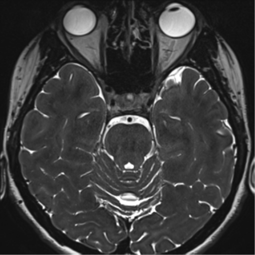File:Abducens nerve palsy (Radiopaedia 51069-56648 Axial T2 fat sat 50).png