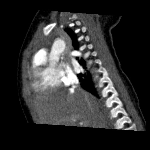 Aberrant left pulmonary artery (pulmonary sling) (Radiopaedia 42323-45435 Sagittal C+ arterial phase 22).jpg