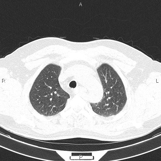 Aberrant right subclavian artery (Radiopaedia 87093-103354 Axial lung window 27).jpg