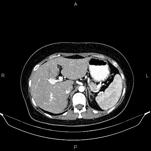 Aberrant right subclavian artery (Radiopaedia 87334-103629 Axial C+ arterial phase 67).jpg