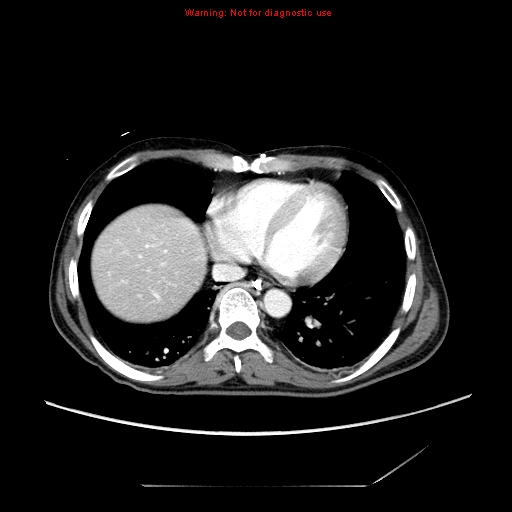 File:Aberrant right subclavian artery (Radiopaedia 9379-10071 Axial C+ arterial phase 47).jpg