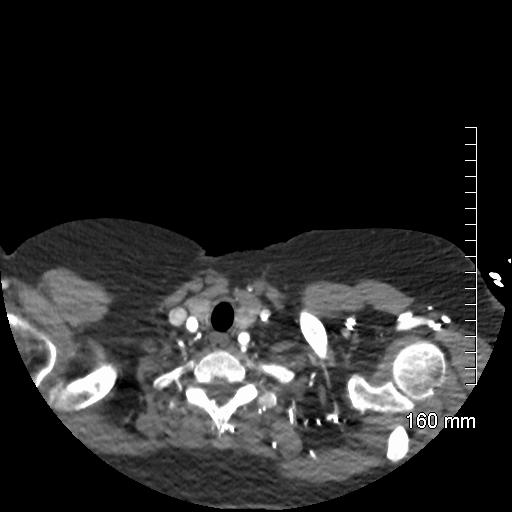 Aberrant right subclavian artery stenosis (Radiopaedia 52656-58670 Axial C+ arterial phase 2).jpg