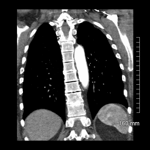 Aberrant right subclavian artery stenosis (Radiopaedia 52656-58670 B 64).jpg