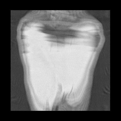 Accessory left horizontal fissure with lingular pneumonia (Radiopaedia 53763-59843 Coronal lung window 45).jpg