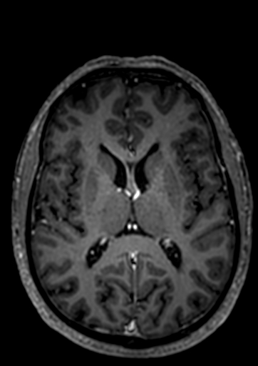 Accessory middle cerebral artery (Radiopaedia 73114-83828 Axial T1 C+ 17).jpg