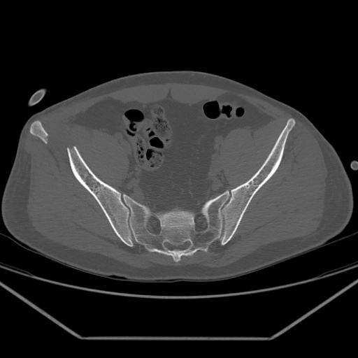 File:Acetabular and ilial fractures (Radiopaedia 59084-66378 Axial bone window 25).jpg