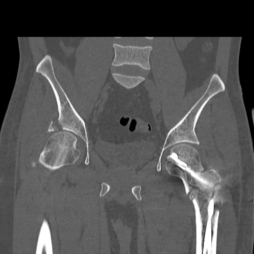 Acetabular and ilial fractures (Radiopaedia 59084-66378 Coronal bone window 26).jpg