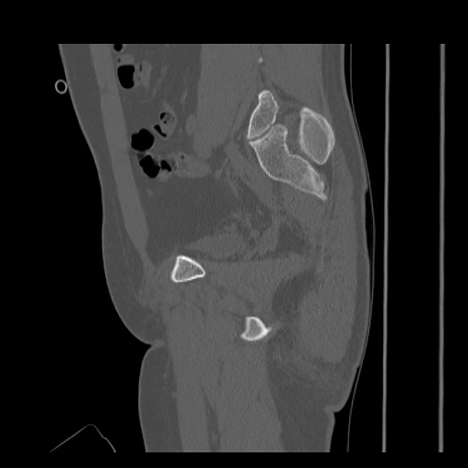 Acetabular and ilial fractures (Radiopaedia 59084-66378 Sagittal bone window 39).jpg