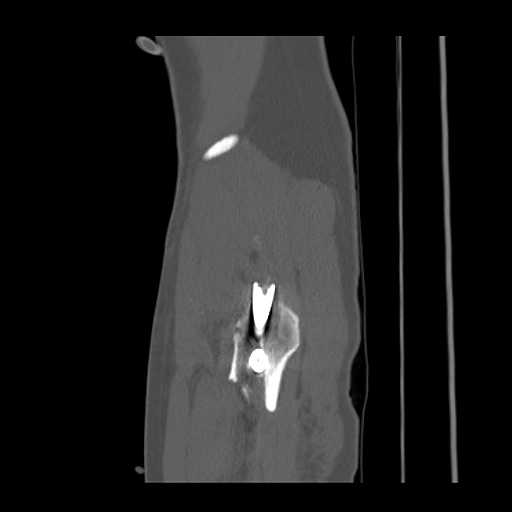 Acetabular and ilial fractures (Radiopaedia 59084-66378 Sagittal bone window 96).jpg