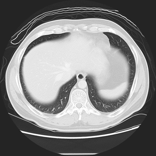 Achalasia (Radiopaedia 8831-9629 Axial lung window 48).jpg