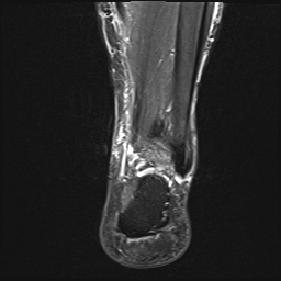 File:Achilles tendon tear (Radiopaedia 77615-89819 Coronal STIR 21).jpg