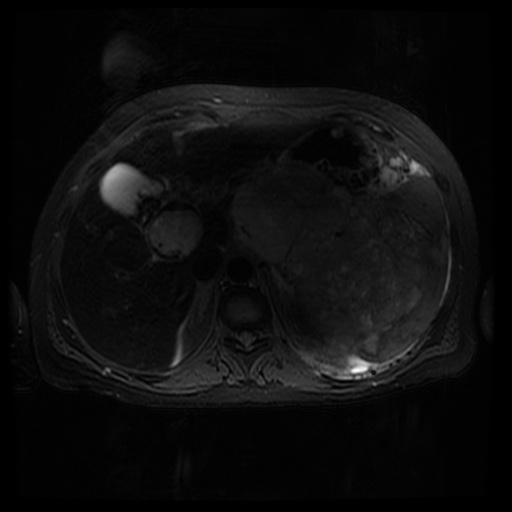 File:Acinar cell carcinoma of the pancreas (Radiopaedia 75442-86668 Axial T2 fat sat 26).jpg