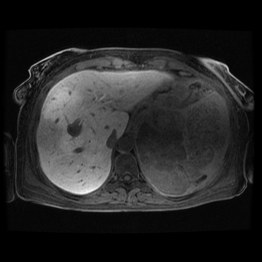 Acinar cell carcinoma of the pancreas (Radiopaedia 75442-86668 Axial late phase (~30 mins) 107).jpg
