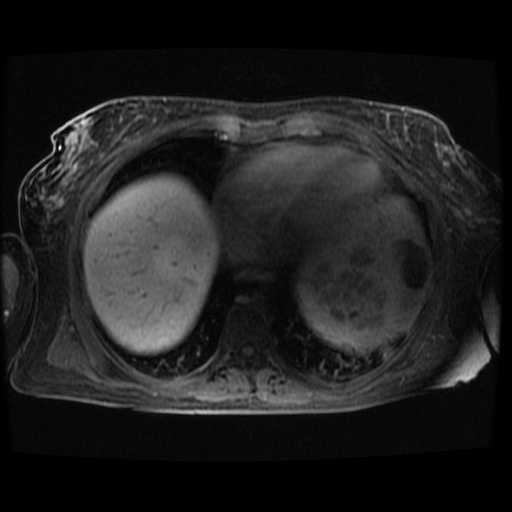 Acinar cell carcinoma of the pancreas (Radiopaedia 75442-86668 Axial late phase (~30 mins) 134).jpg