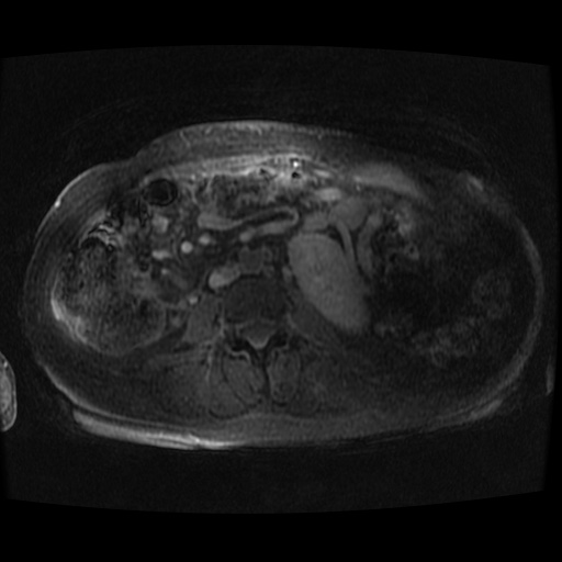 Acinar cell carcinoma of the pancreas (Radiopaedia 75442-86668 Axial late phase (~30 mins) 5).jpg