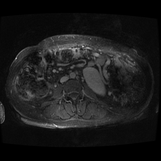 Acinar cell carcinoma of the pancreas (Radiopaedia 75442-86668 D 5).jpg
