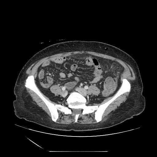 Acinar cell carcinoma of the pancreas (Radiopaedia 75442-86669 Axial C+ portal venous phase 102).jpg