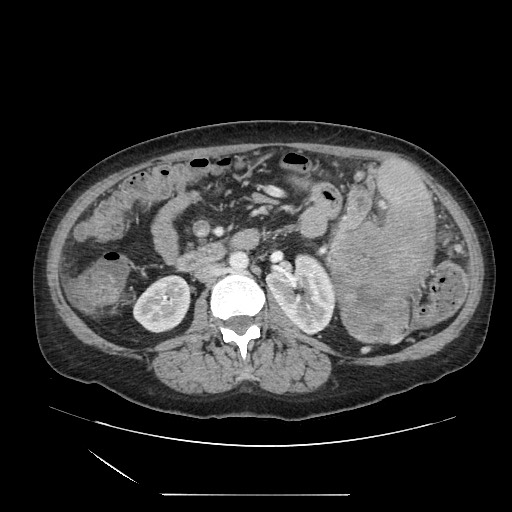 Acinar cell carcinoma of the pancreas (Radiopaedia 75442-86669 Axial C+ portal venous phase 68).jpg