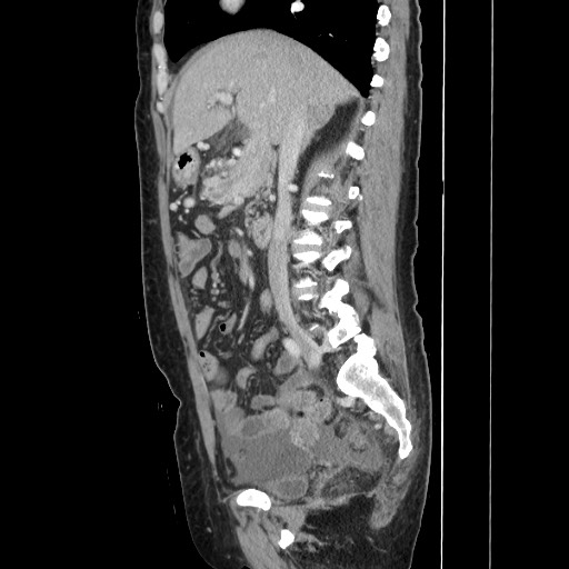 Acinar cell carcinoma of the pancreas (Radiopaedia 75442-86669 Sagittal C+ portal venous phase 84).jpg