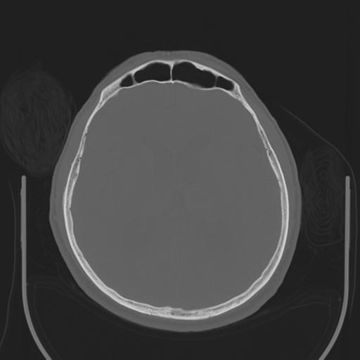 File:Acoustic schwannoma (Radiopaedia 29488-29982 AXIAL BONE THICK non-contrast 27).jpg