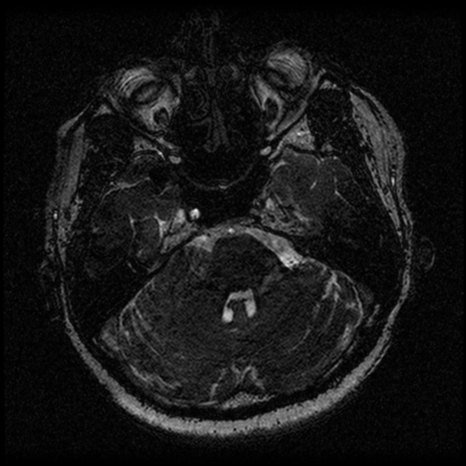 File:Acoustic schwannoma (Radiopaedia 33045-34060 Axial T2 36).png