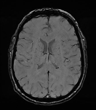 Acoustic schwannoma (Radiopaedia 50846-56358 Axial SWI 56).png