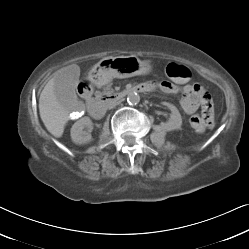 Active bleeding from duodenal ulcer with embolization (Radiopaedia 34216-35481 Axial non-contrast 27).png