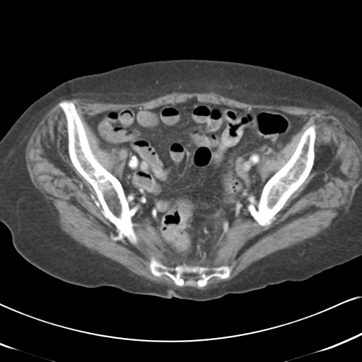 Active bleeding from duodenal ulcer with embolization (Radiopaedia 34216-35481 C 53).png