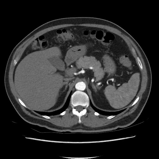 File:Active colonic bleed on CT (Radiopaedia 49765-55025 Axial C+ arterial phase 23).jpg