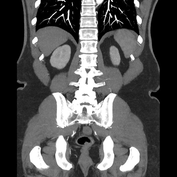 Active colonic bleed on CT (Radiopaedia 49765-55025 Coronal art MIP 47).jpg