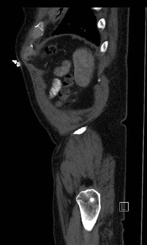 Active lower gastrointestinal bleeding - diverticular (Radiopaedia 61203-69106 Sagittal C+ arterial phase 13).jpg