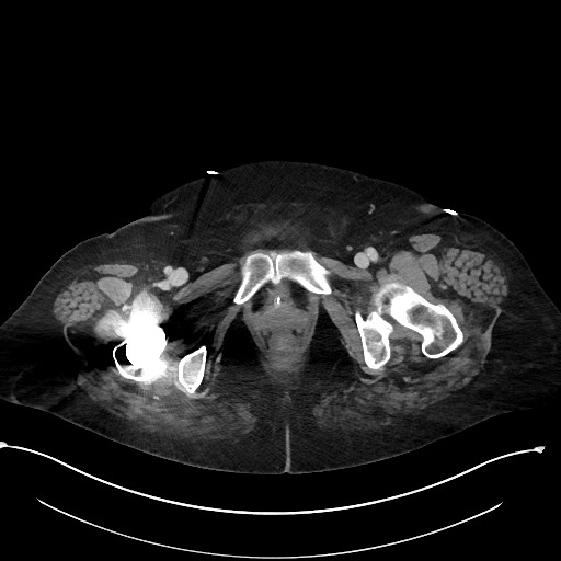 File:Active renal extravasation with large subcapsular and retroperitoneal hemorrhage (Radiopaedia 60975-68796 Axial 336).jpg